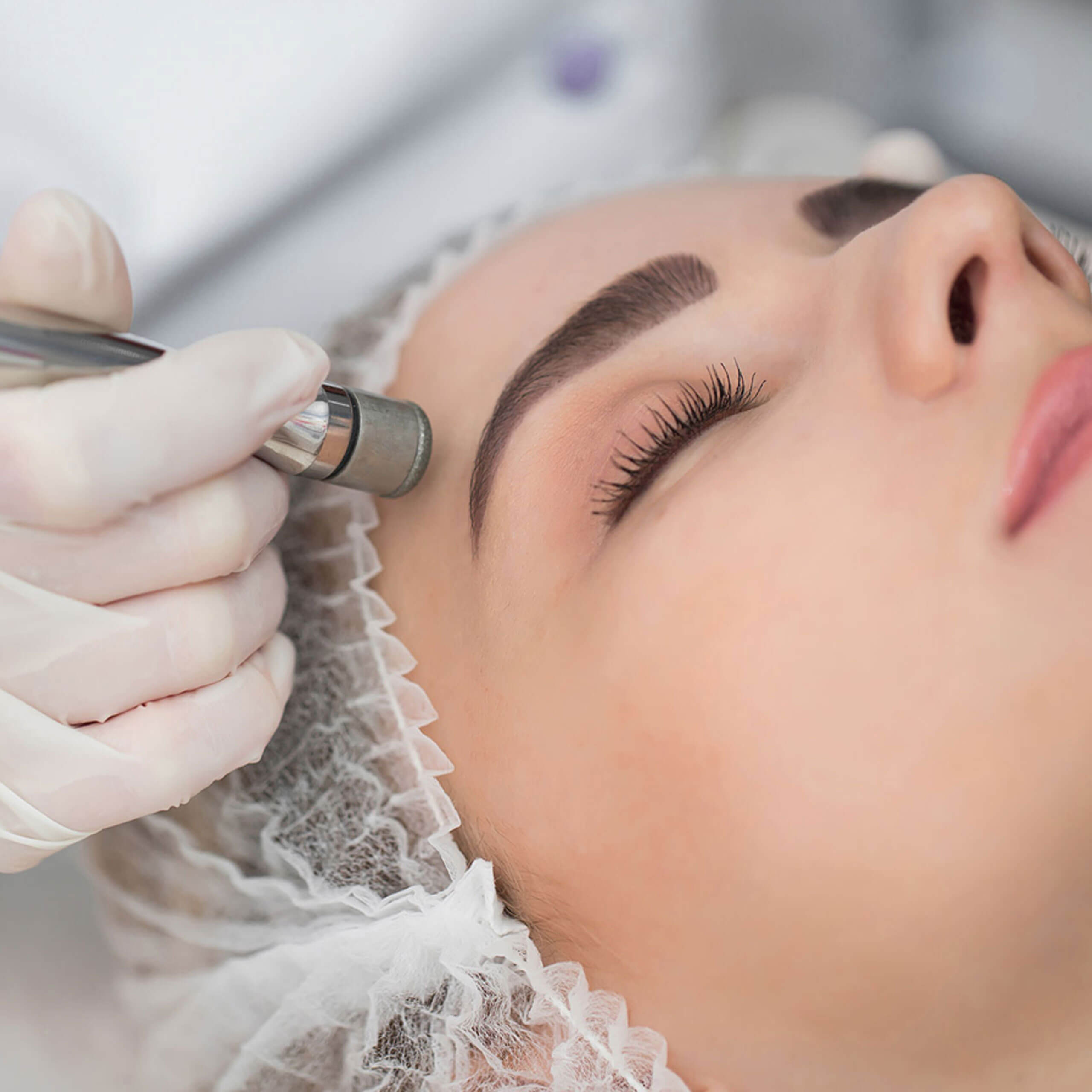 Microdermabrasion