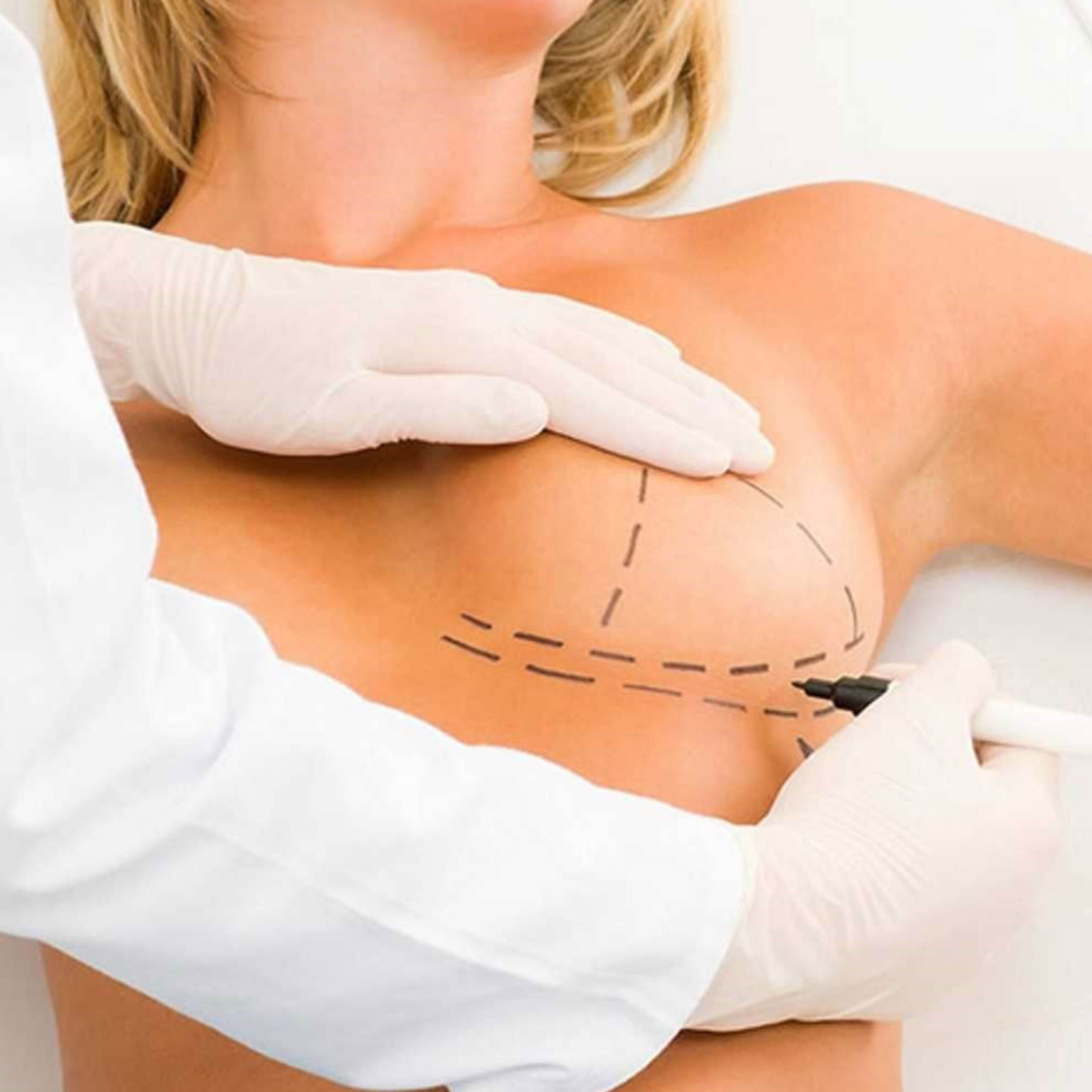 Breast Lift - Mastopexy