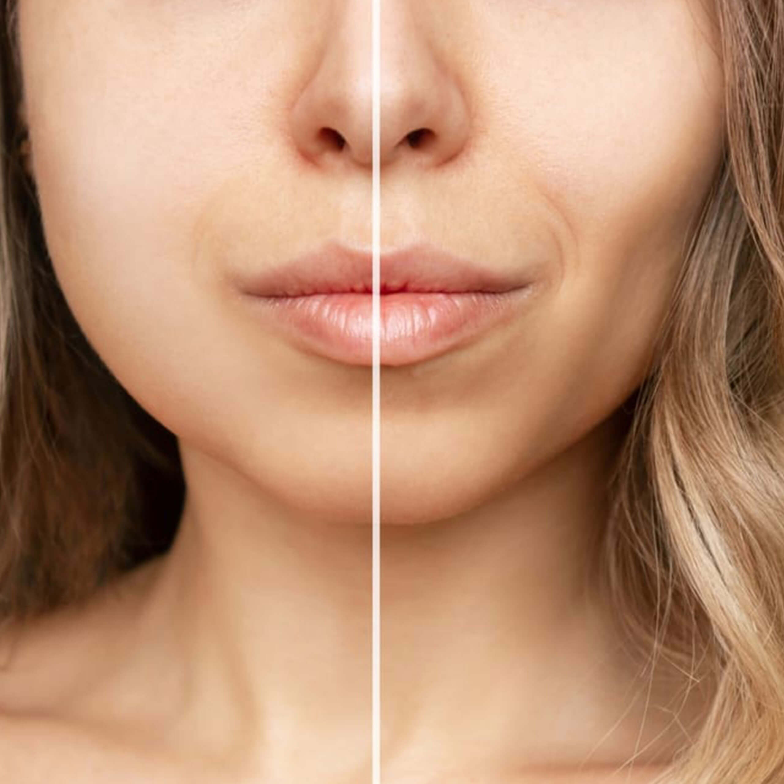 Buccal Fat Removal - Bichectomy