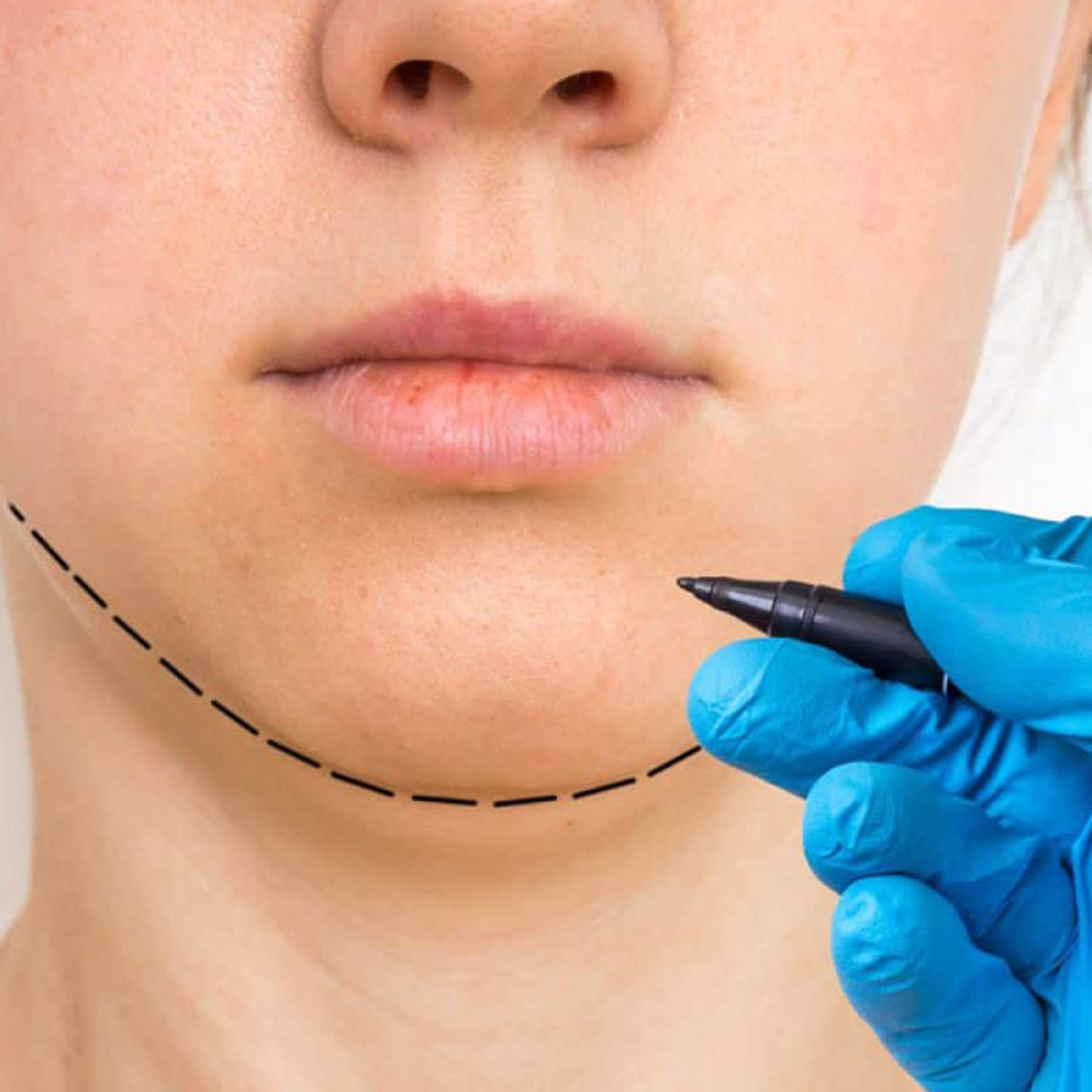 Chin Implant - Mentoplasty