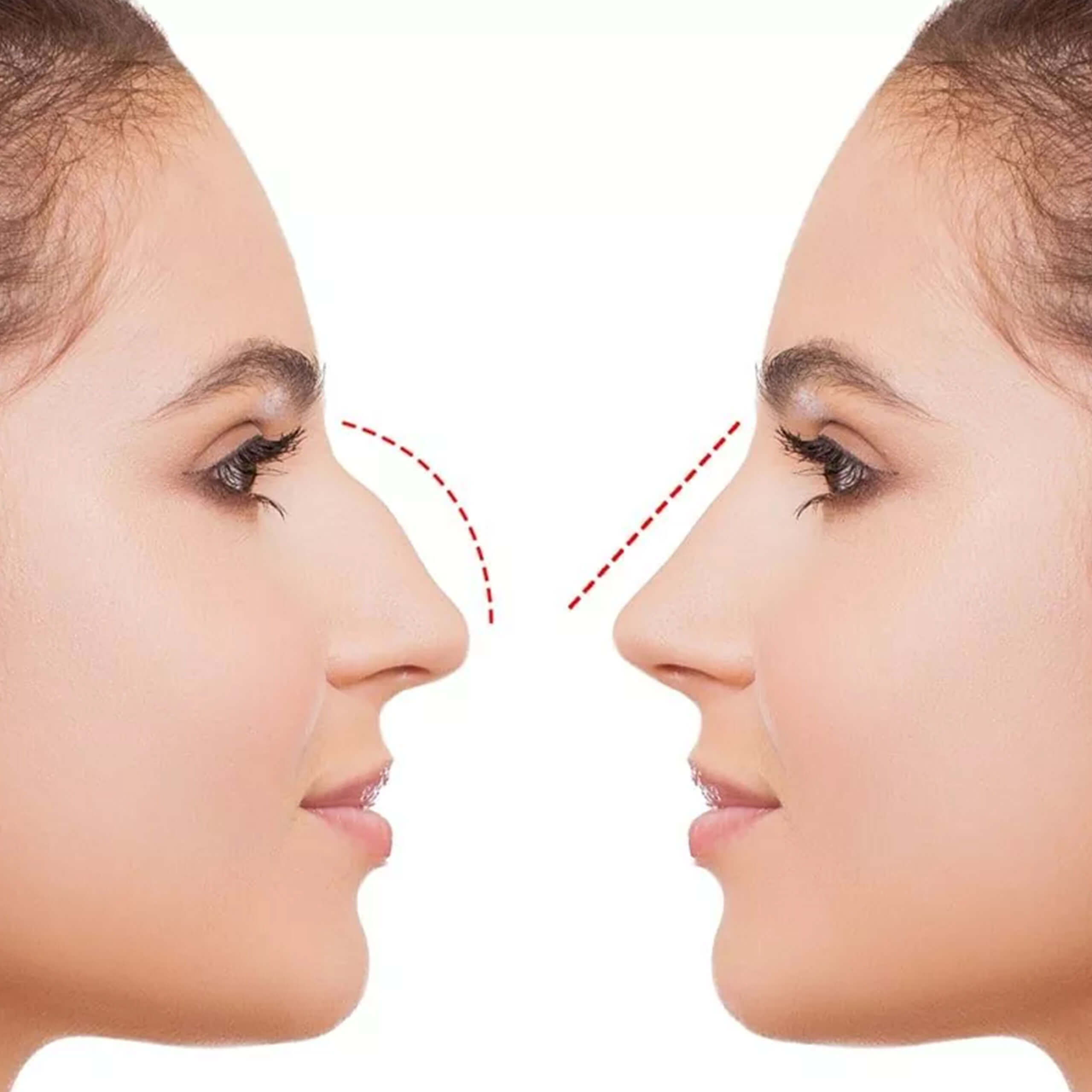 Rhinoplasty
