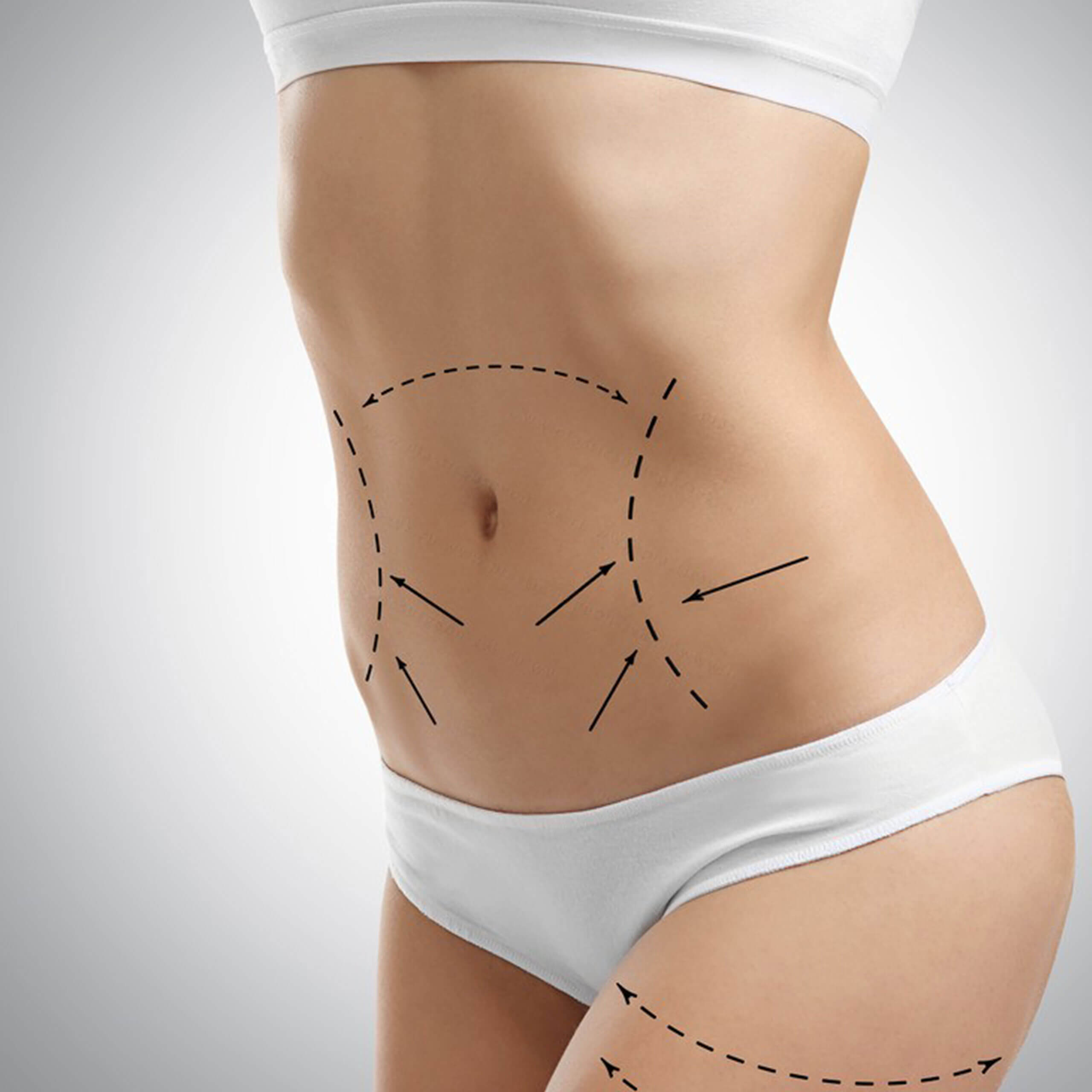 Tummy Tuck - Abdominoplasty