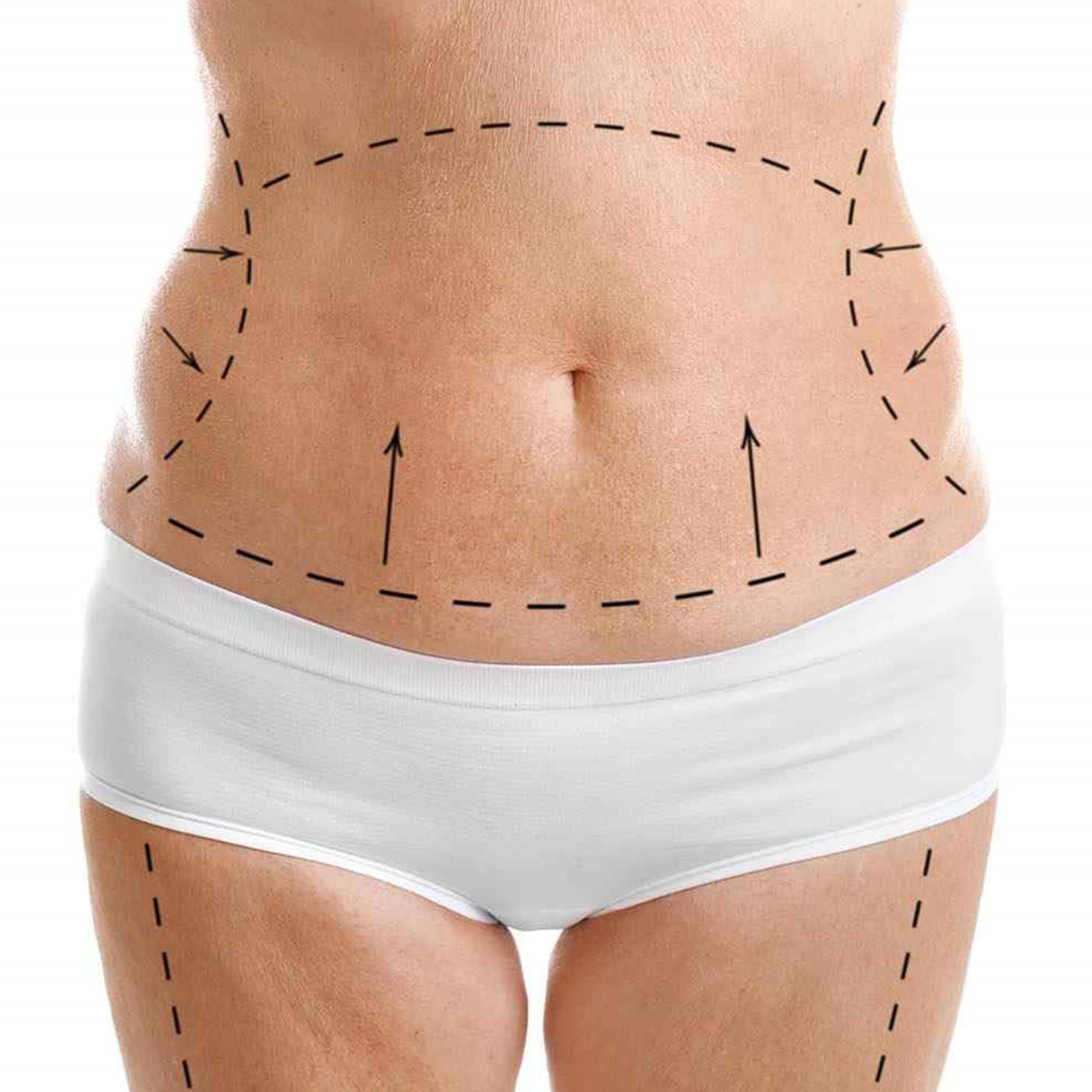 Tummy Tuck
