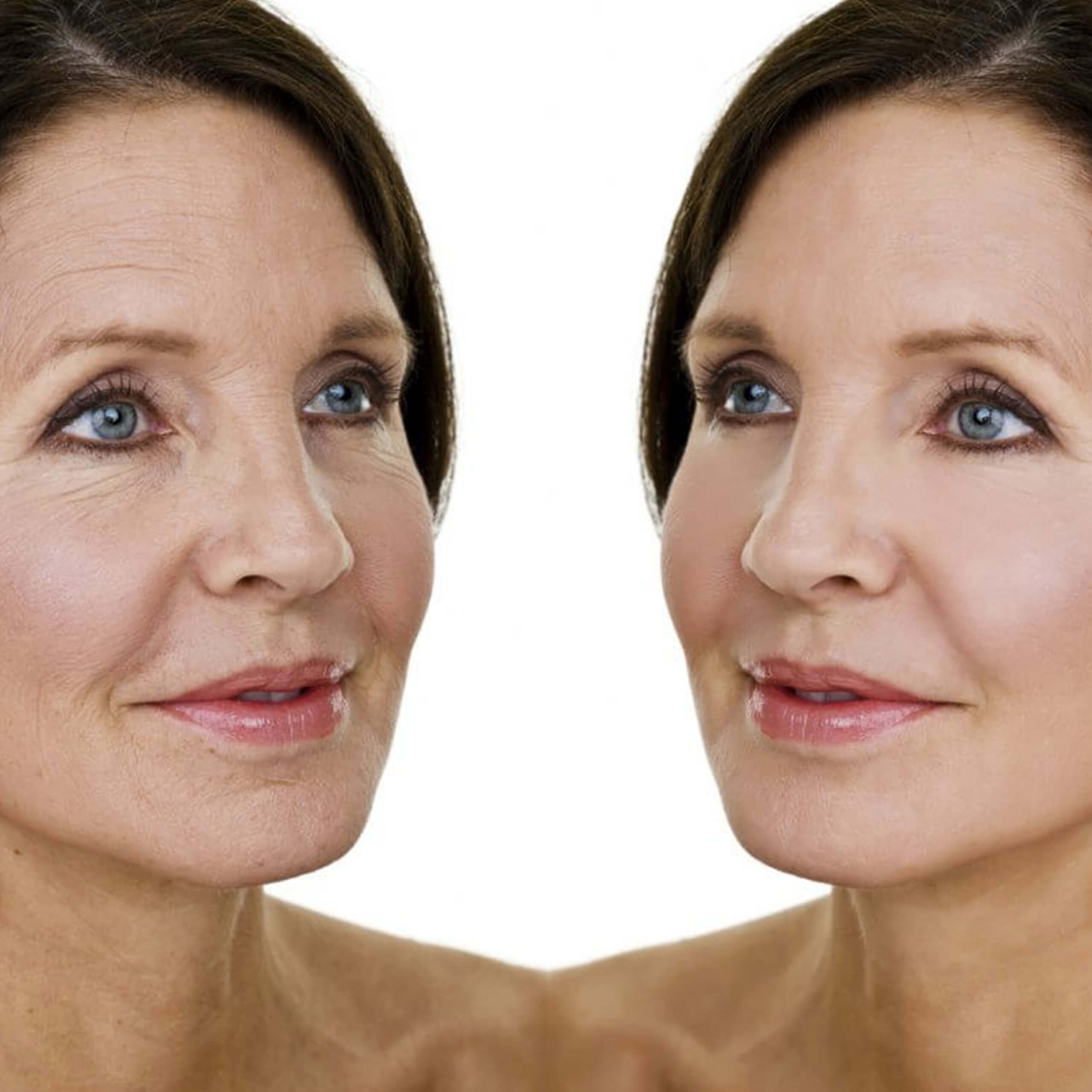 Rejuvenecimiento Facial