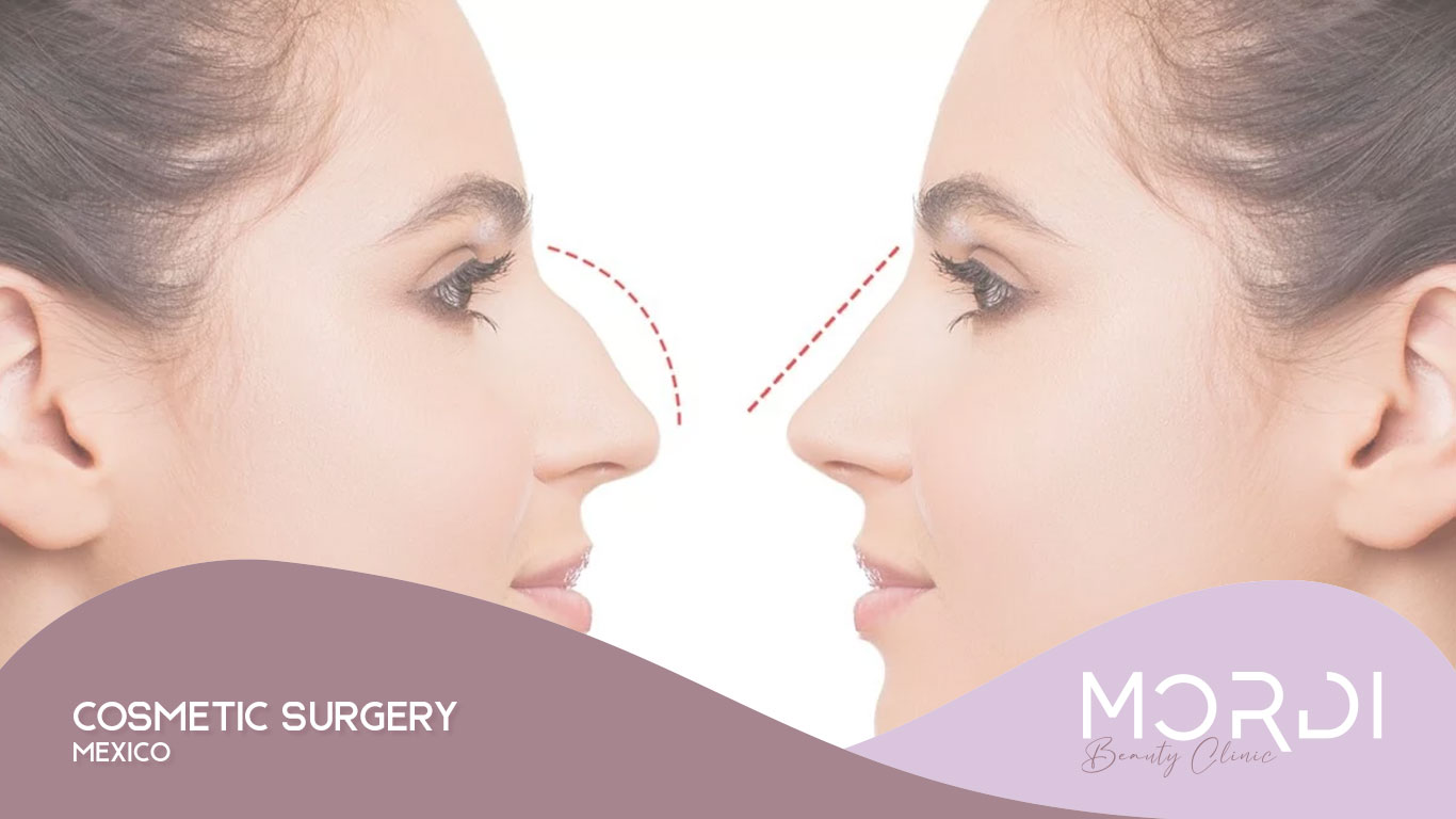 Cosmetic Surgery Mexico