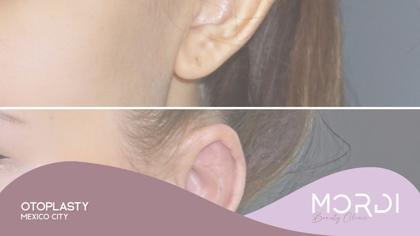 Otoplasty Mexico City