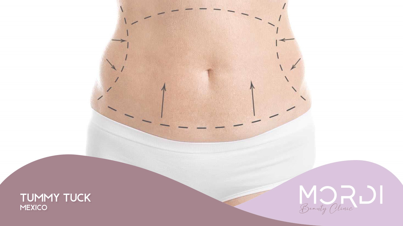 Tummy Tuck Mexico