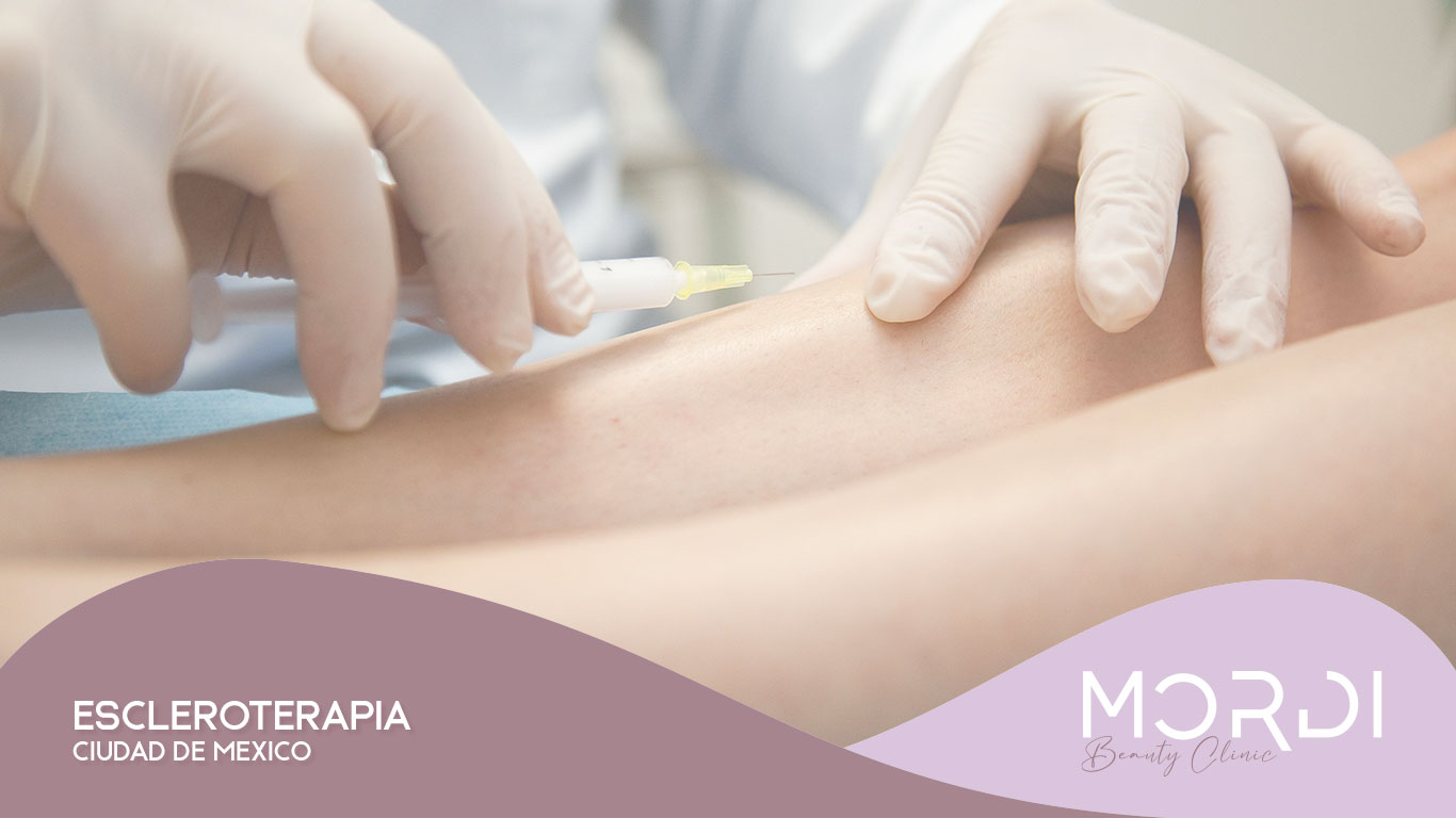 Escleroterapia Ciudad de México