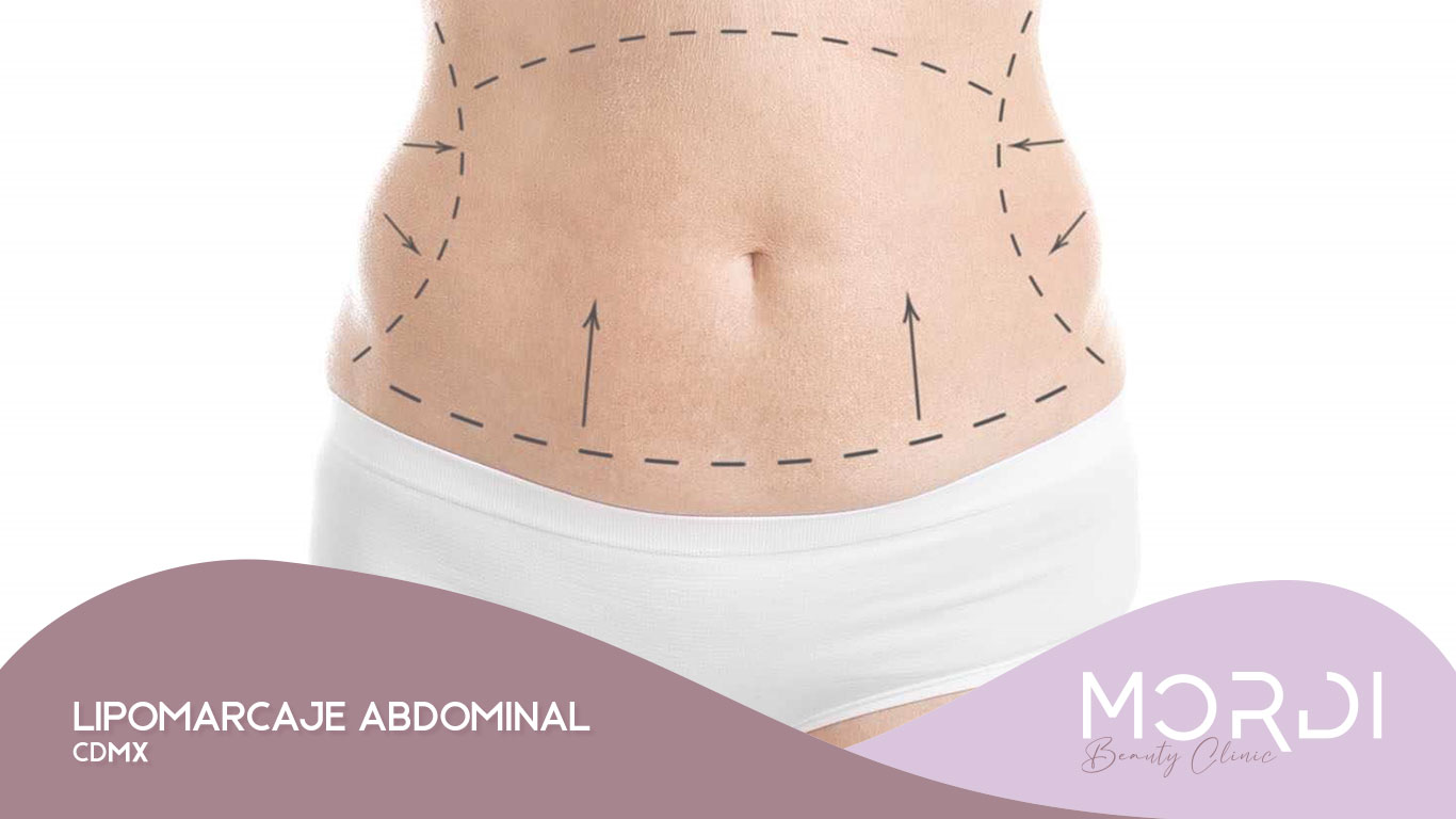 Lipomarcaje Abdominal CDMX