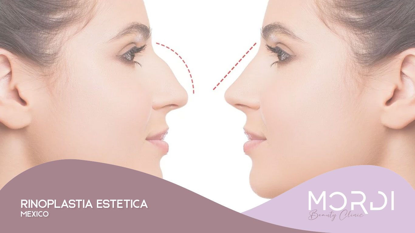 Rinoplastia Estética México